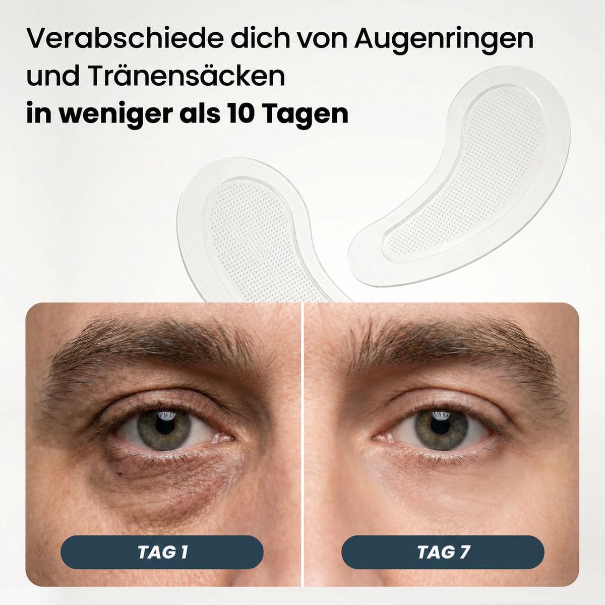 Onalumi™ Microneedle Eye Patches