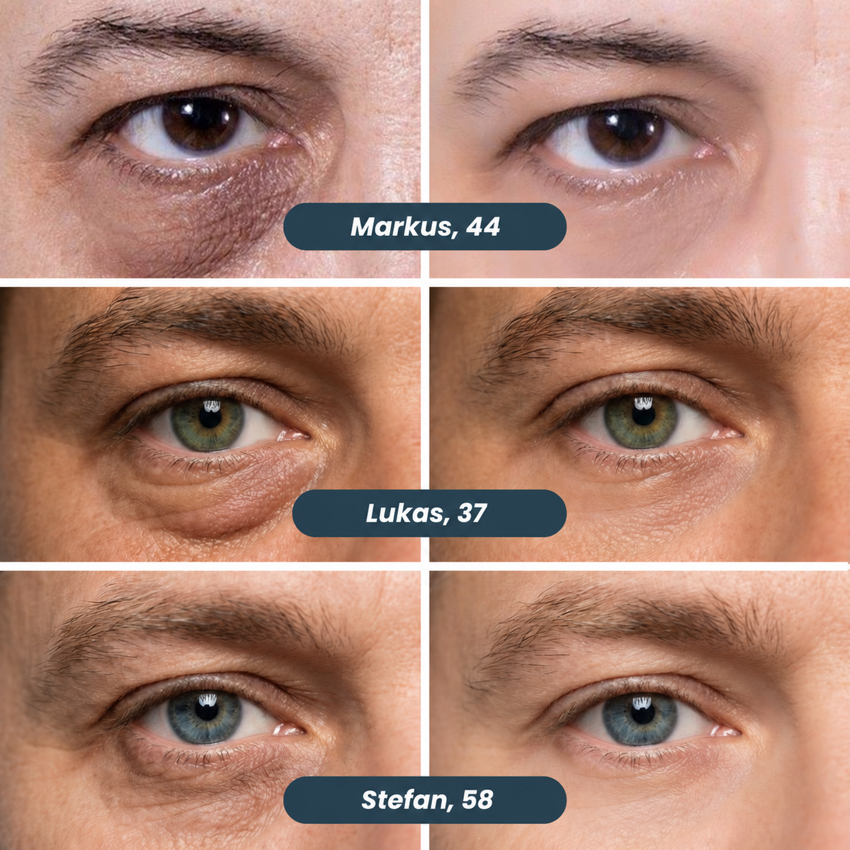 Onalumi™ Microneedle Eye Patches